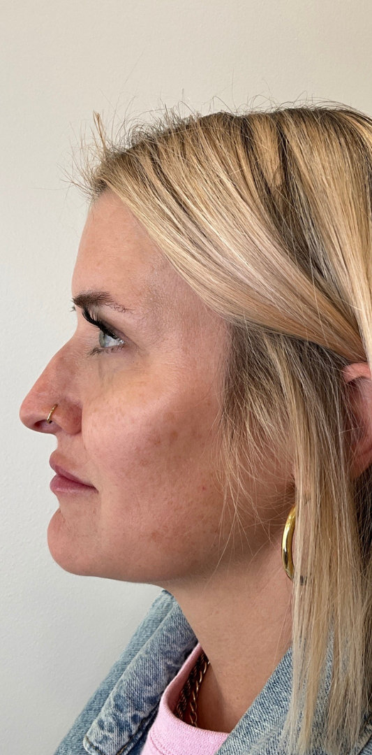 Lip Fillers Before & After Image