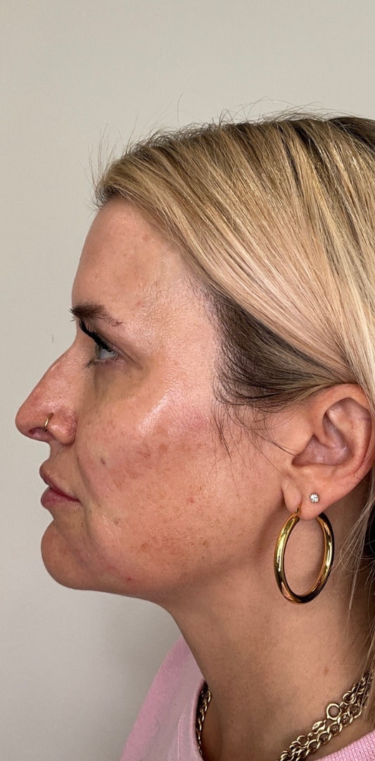 Lip Fillers Before & After Image