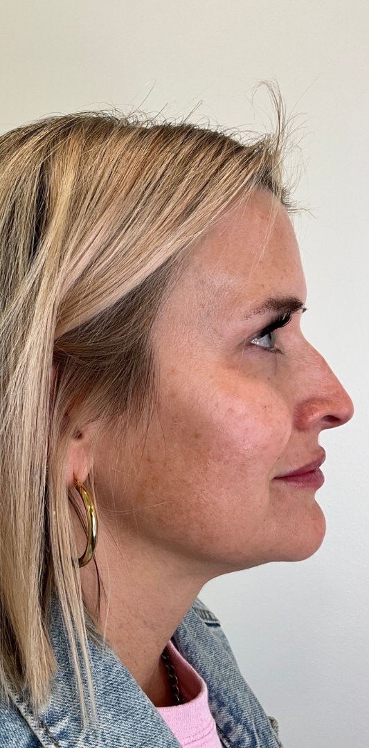 Lip Fillers Before & After Image
