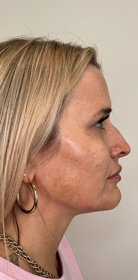 Lip Fillers Before & After Image