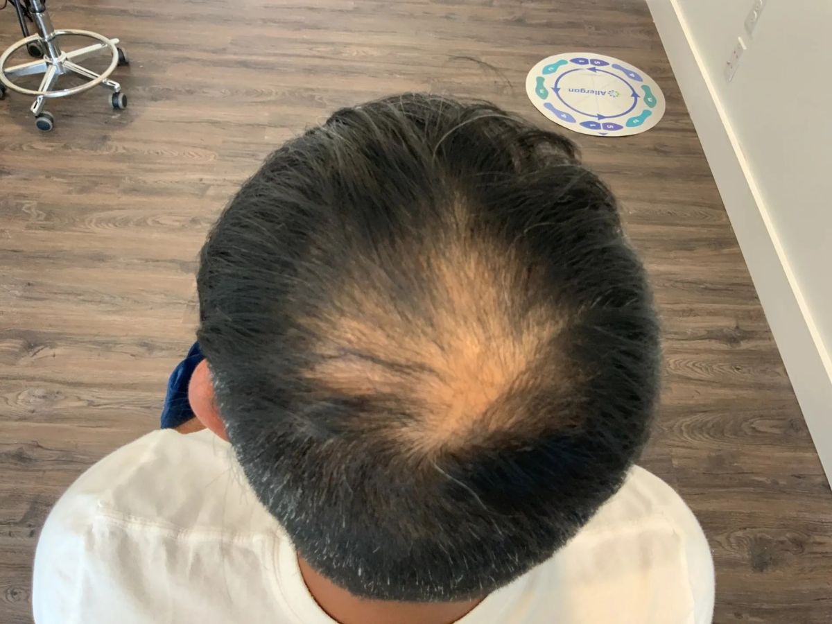 PRP Hair Restoration Before & After Image