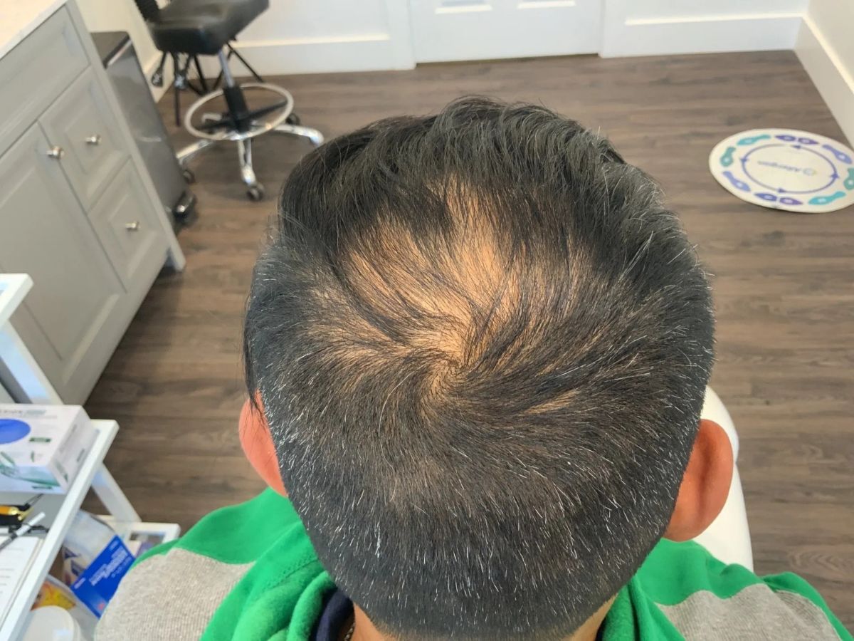 PRP Hair Restoration Before & After Image