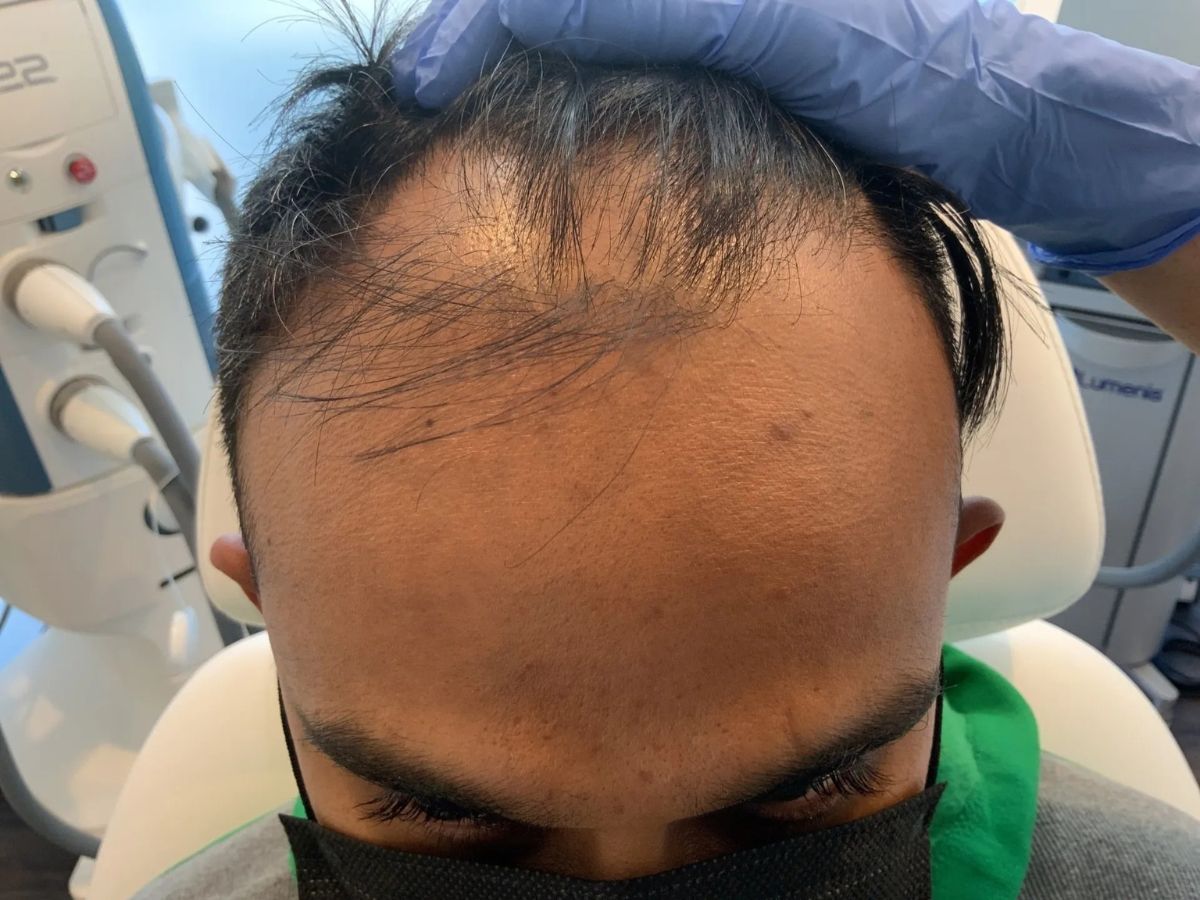 PRP Hair Restoration Before & After Image