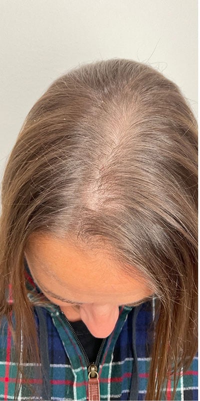 PRP Hair Restoration Before & After Image