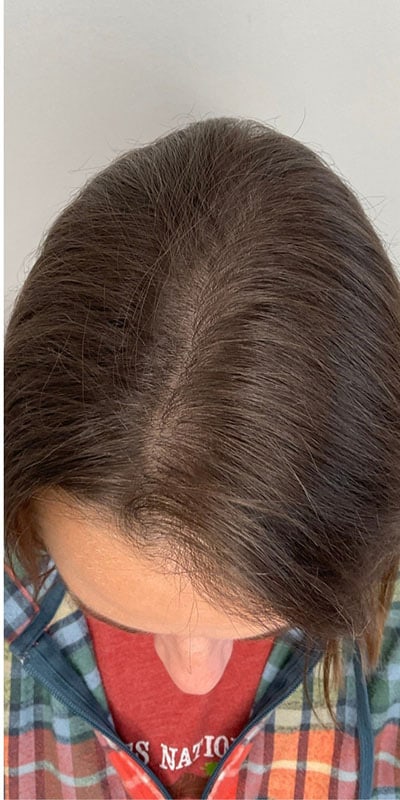 PRP Hair Restoration Before & After Image