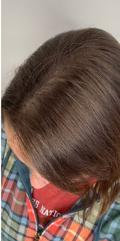 PRP Hair Restoration Before & After Image