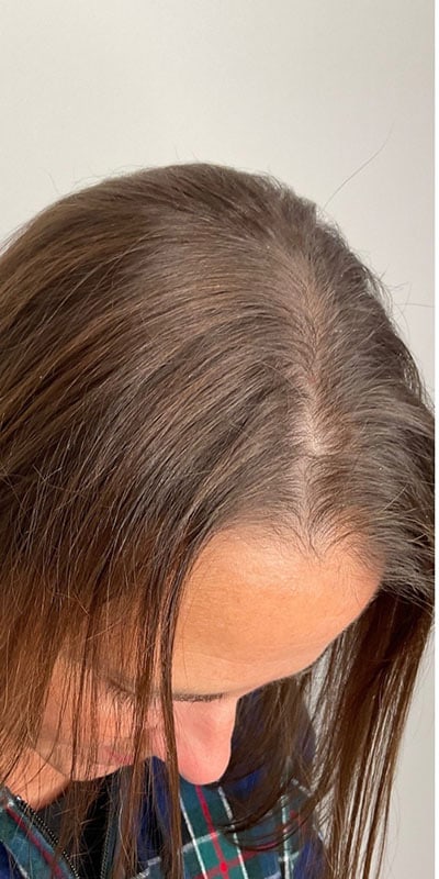 PRP Hair Restoration Before & After Image