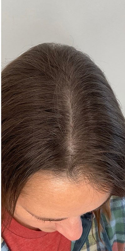 PRP Hair Restoration Before & After Image