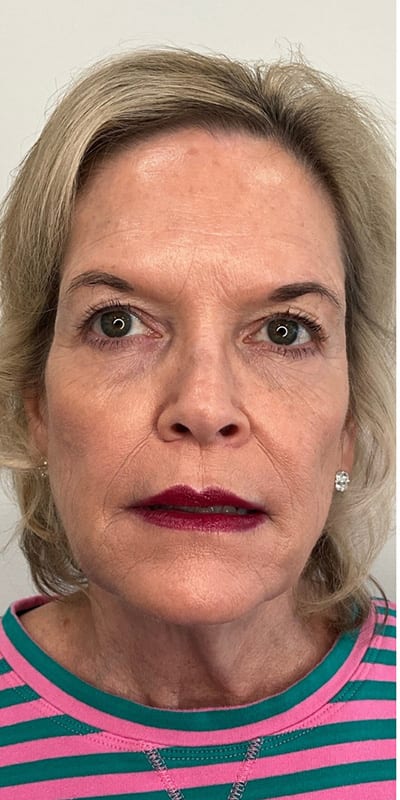 Sculptra Before & After Image