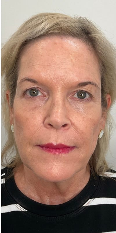 Sculptra Before & After Image