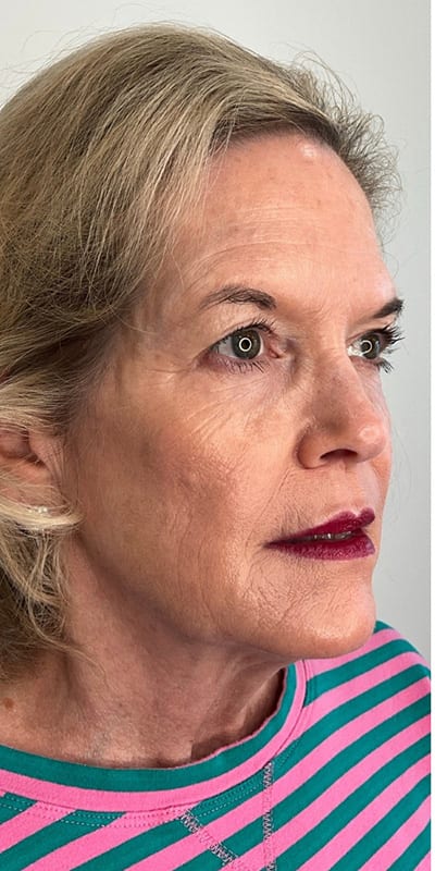 Sculptra Before & After Image