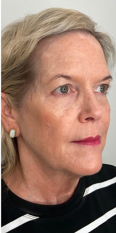 Sculptra Before & After Image