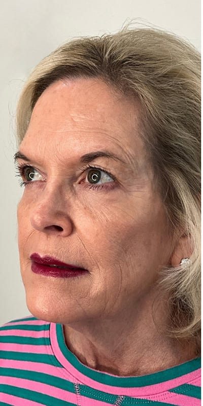 Sculptra Before & After Image