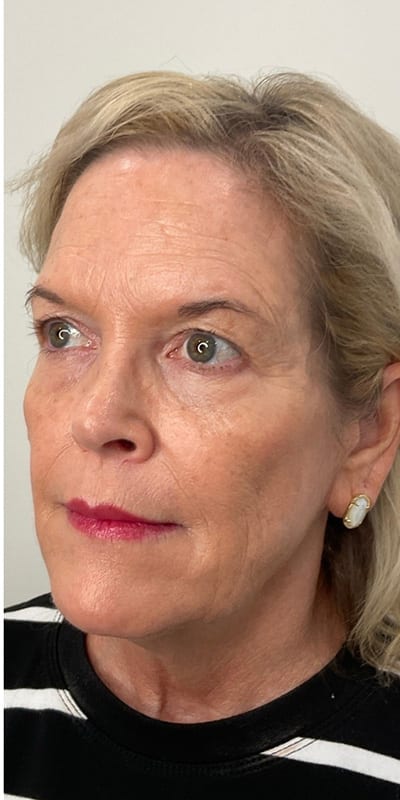 Sculptra Before & After Image