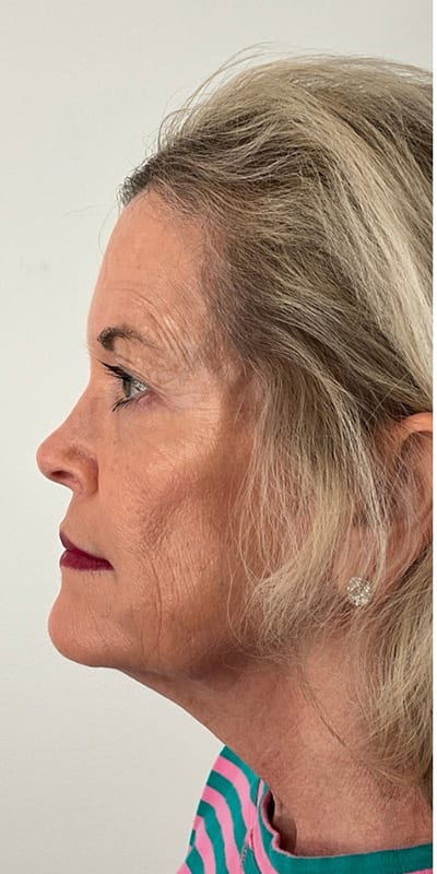 Sculptra Before & After Image