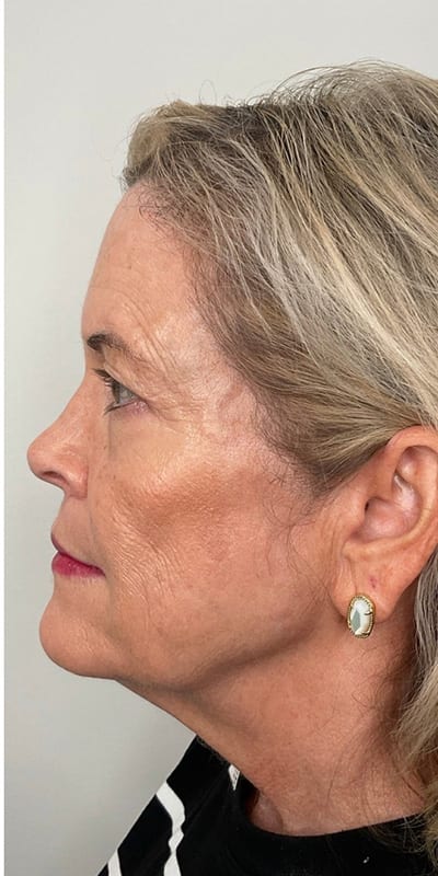 Sculptra Before & After Image