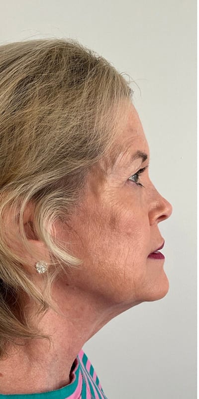 Sculptra Before & After Image