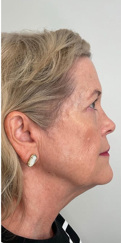 Sculptra Before & After Image