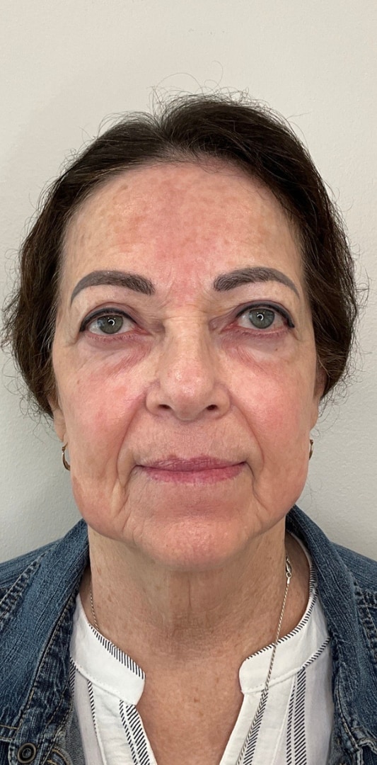 HALO TRIBRID Laser Before & After Image