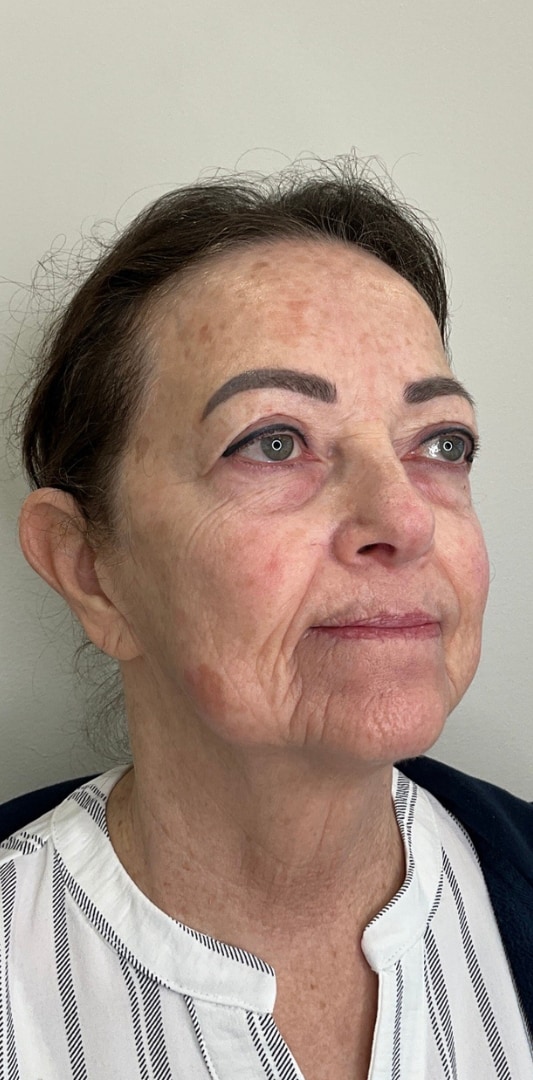HALO TRIBRID Laser Before & After Image