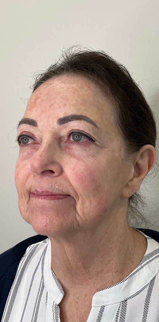 HALO TRIBRID Laser Before & After Image
