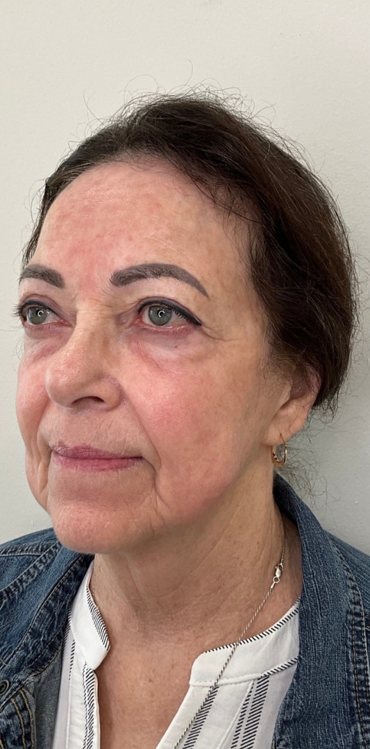 HALO TRIBRID Laser Before & After Image