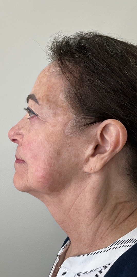 HALO TRIBRID Laser Before & After Image
