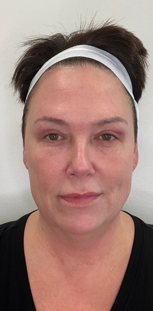 HALO TRIBRID Laser Before & After Image