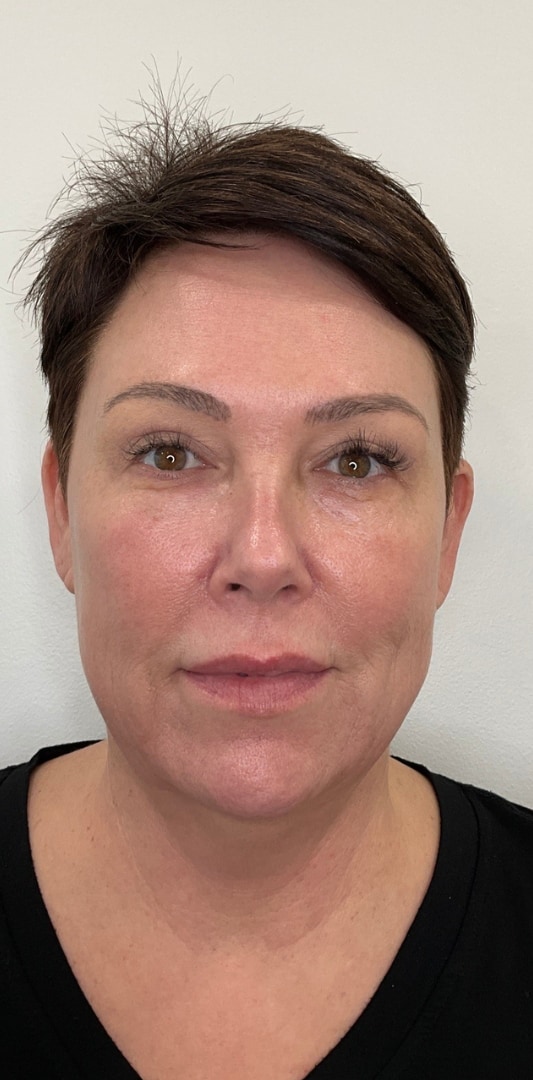 HALO TRIBRID Laser Before & After Image