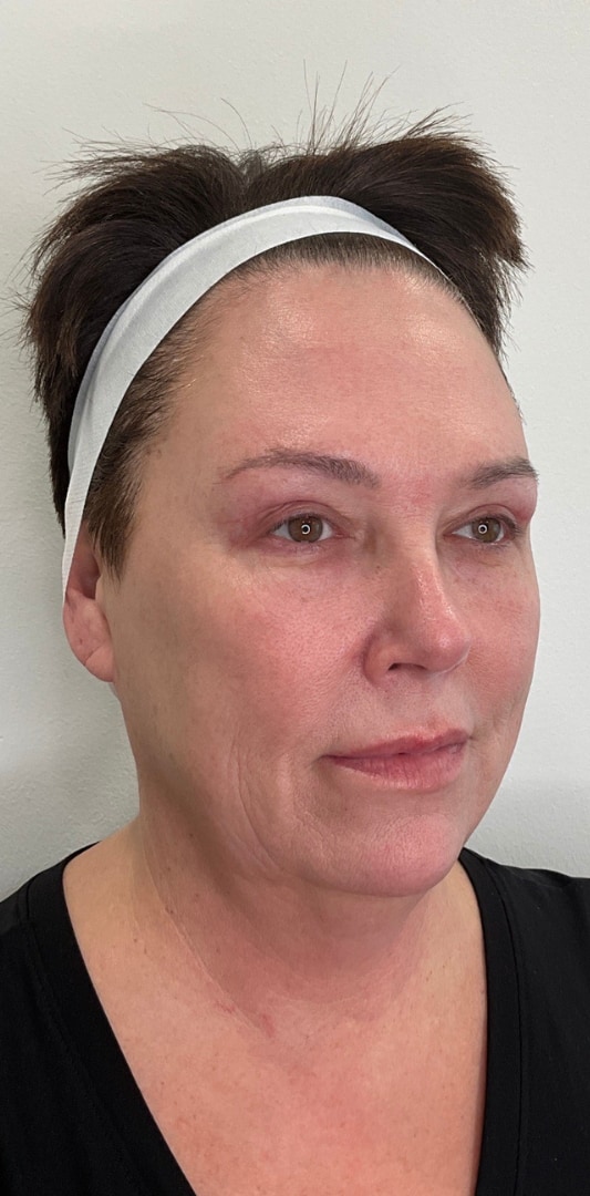 HALO TRIBRID Laser Before & After Image