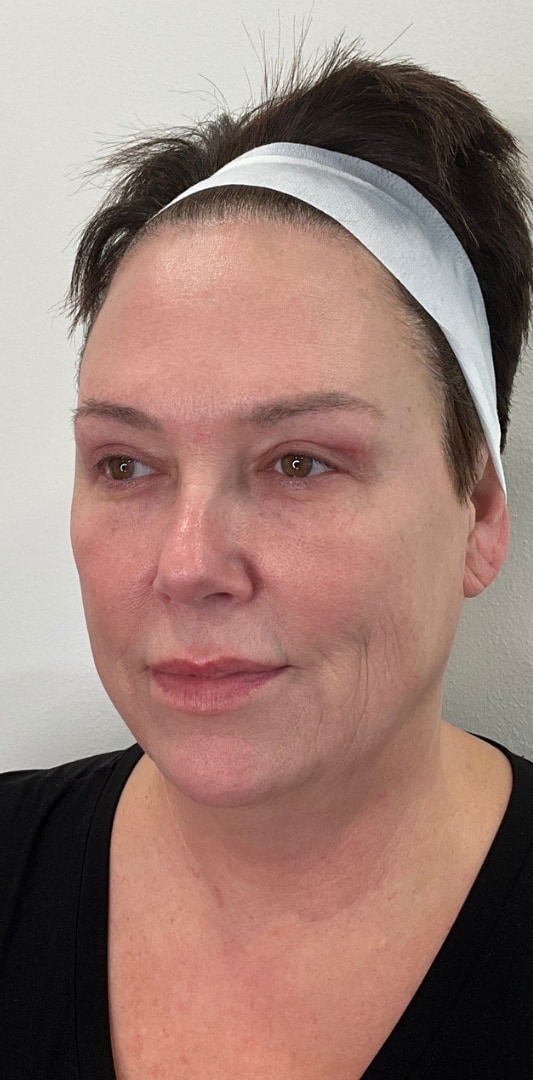 HALO TRIBRID Laser Before & After Image