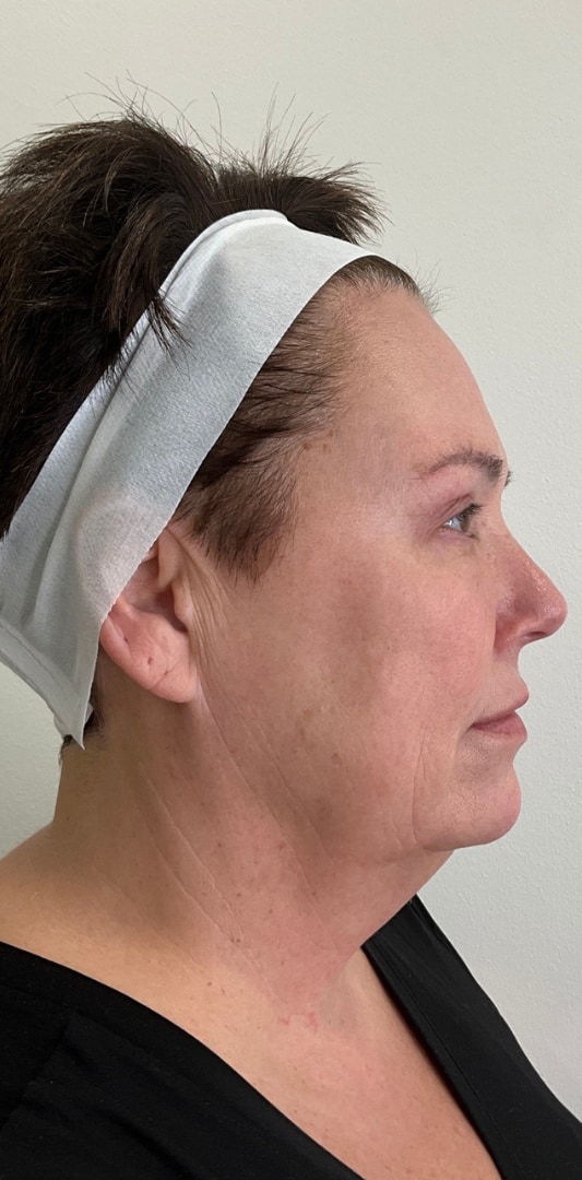 HALO TRIBRID Laser Before & After Image