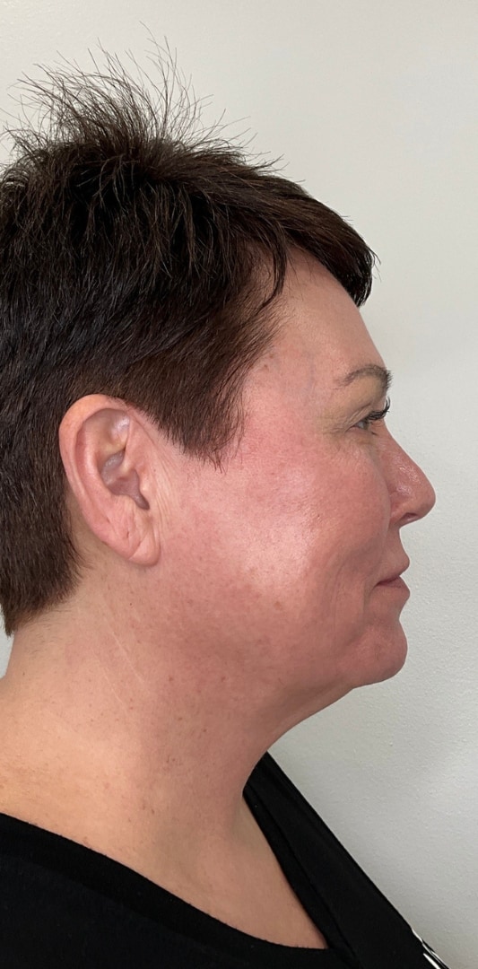 HALO TRIBRID Laser Before & After Image