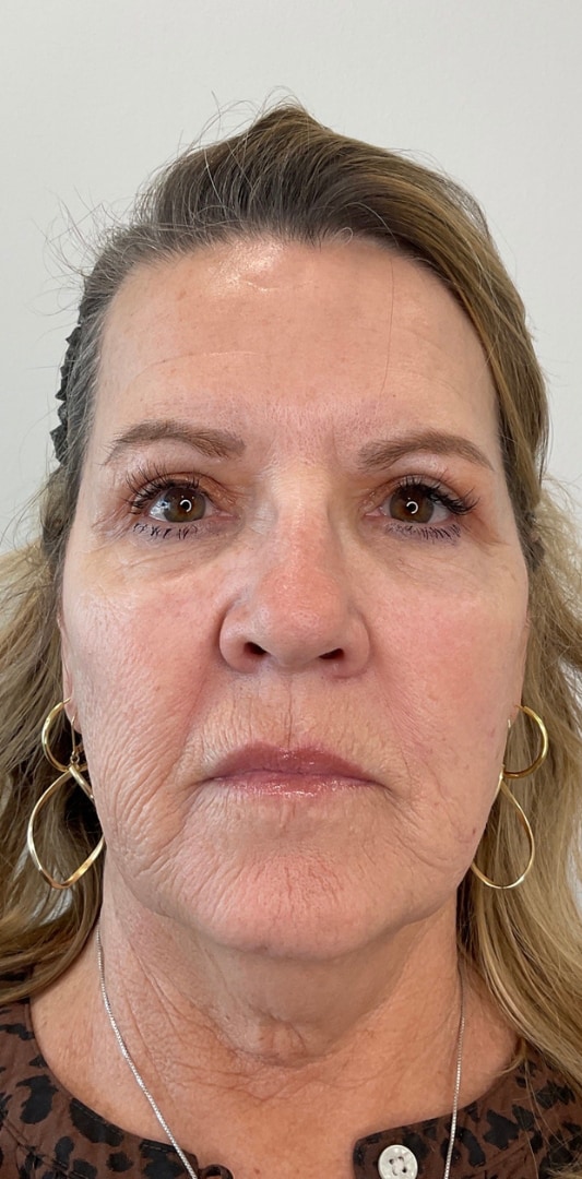 HALO TRIBRID Laser Before & After Image