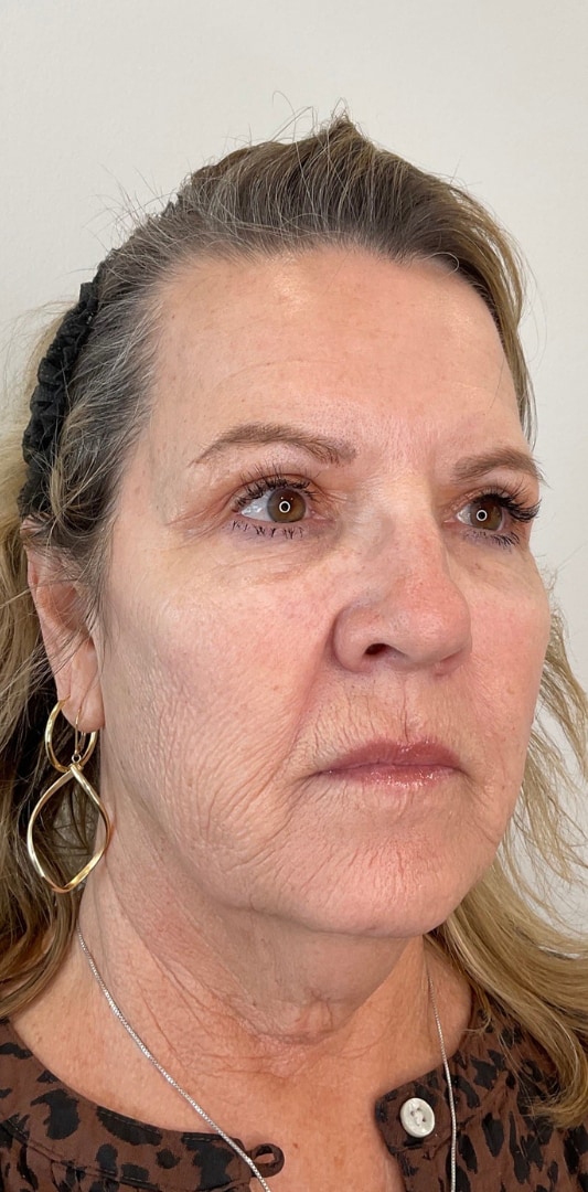 HALO TRIBRID Laser Before & After Image