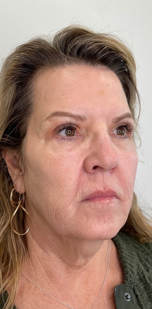 HALO TRIBRID Laser Before & After Image
