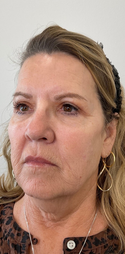 HALO TRIBRID Laser Before & After Image