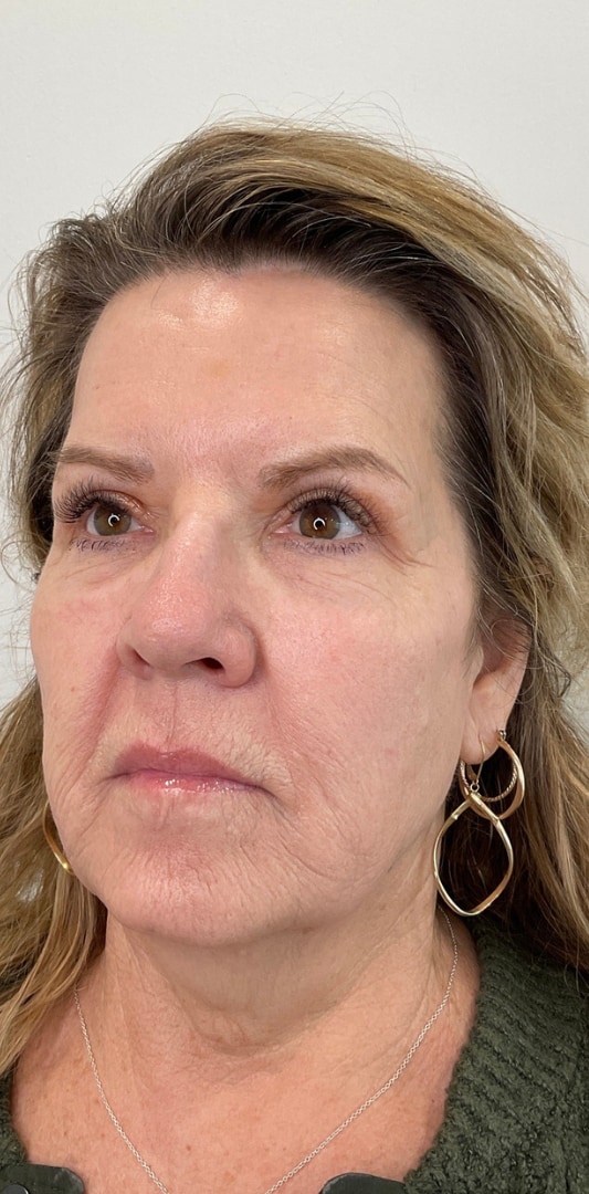 HALO TRIBRID Laser Before & After Image
