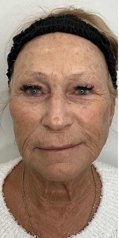 Sciton MOXI Before & After Image