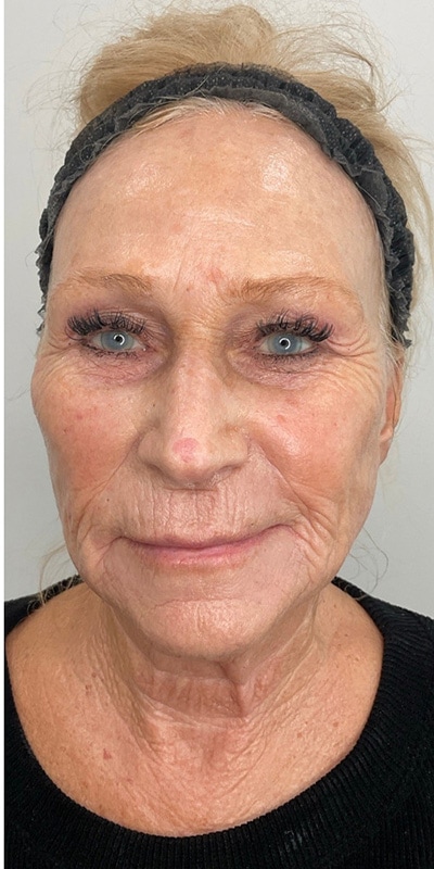 Sciton MOXI Before & After Image