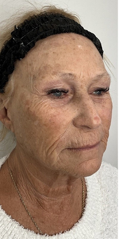 Sciton MOXI Before & After Image