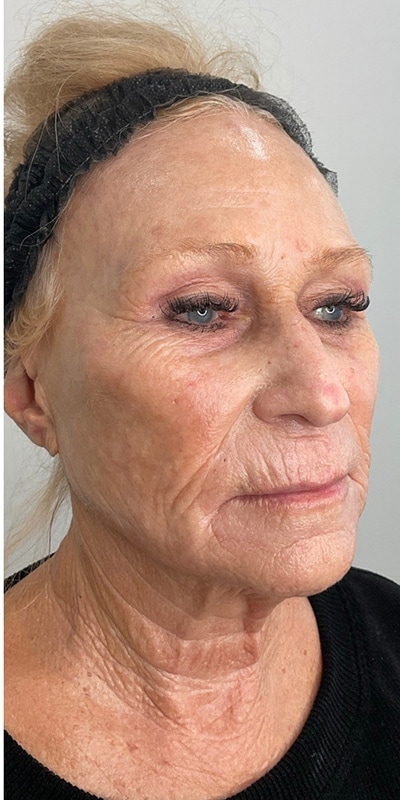 Sciton MOXI Before & After Image