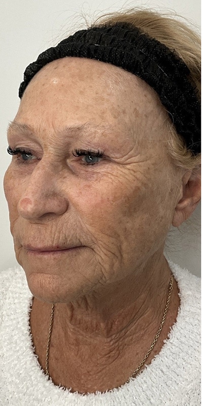 Sciton MOXI Before & After Image
