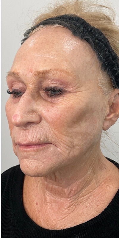 Sciton MOXI Before & After Image