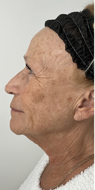 Sciton MOXI Before & After Image