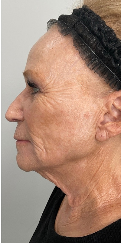 Sciton MOXI Before & After Image