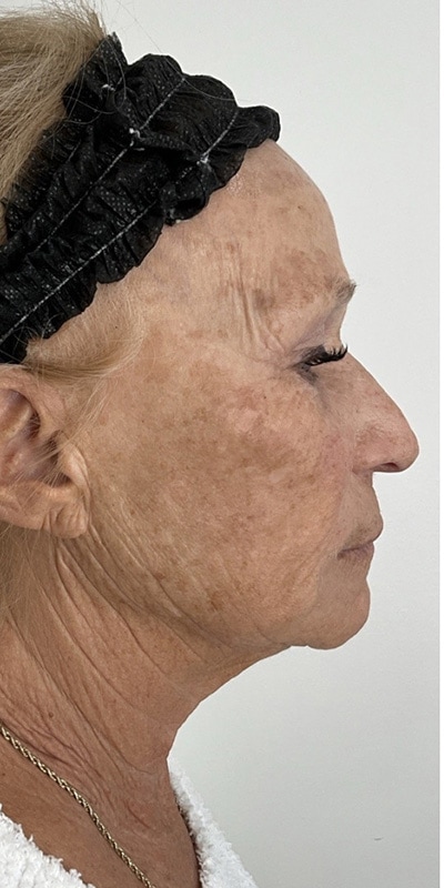 Sciton MOXI Before & After Image