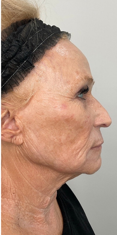 Sciton MOXI Before & After Image