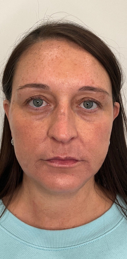 Sciton MOXI Before & After Image