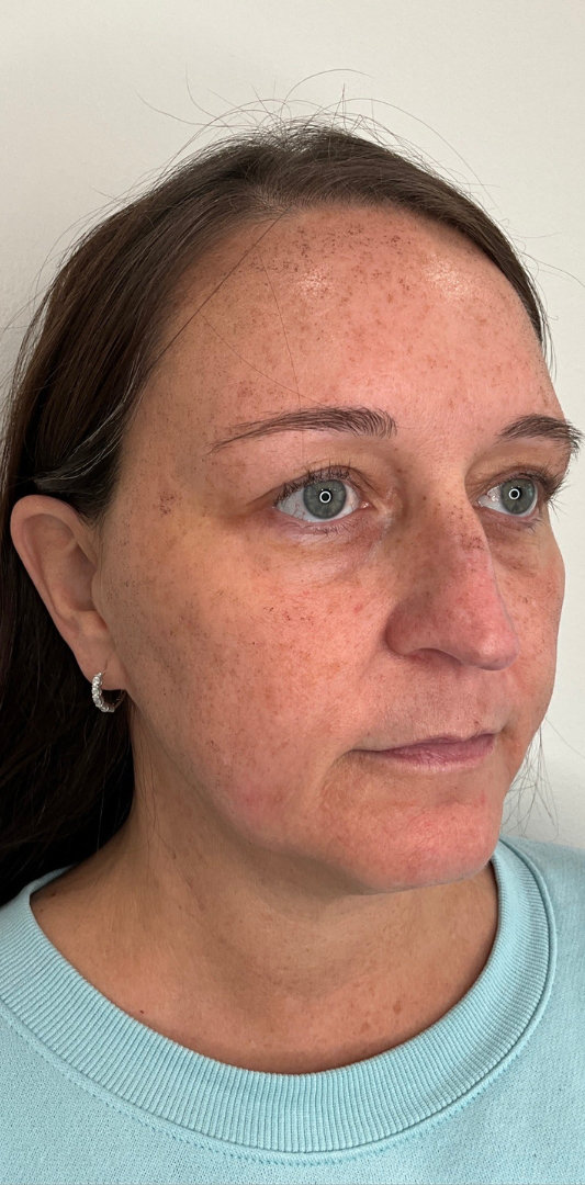 Sciton MOXI Before & After Image